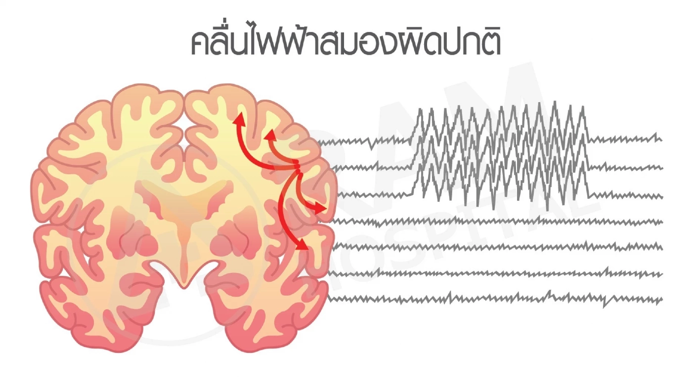 หนึ่งภัยเงียบอย่าชะล่าใจ "โรคลมชัก" พบเร็ว รักษาได้ โอกาสหายสูง