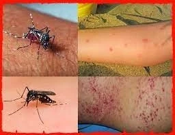 กรมควบคุมโรค จ่อประกาศ 18 จังหวัด "ไข้เลือดออก" ระบาดหนัก หลังยอดผู้ป่วยพุ่ง