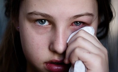 เปิดวิธีป้องกัน "ตาแดง" หนึ่งโรคระบาดที่คนไทย ควระวังในช่วงหน้าฝนนี้ 