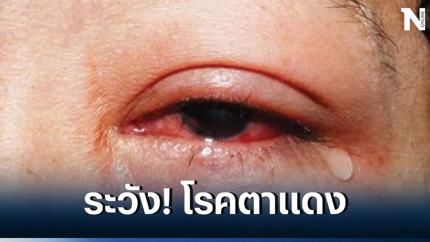 เปิดวิธีป้องกัน "ตาแดง" หนึ่งโรคระบาดที่คนไทย ควระวังในช่วงหน้าฝนนี้ 