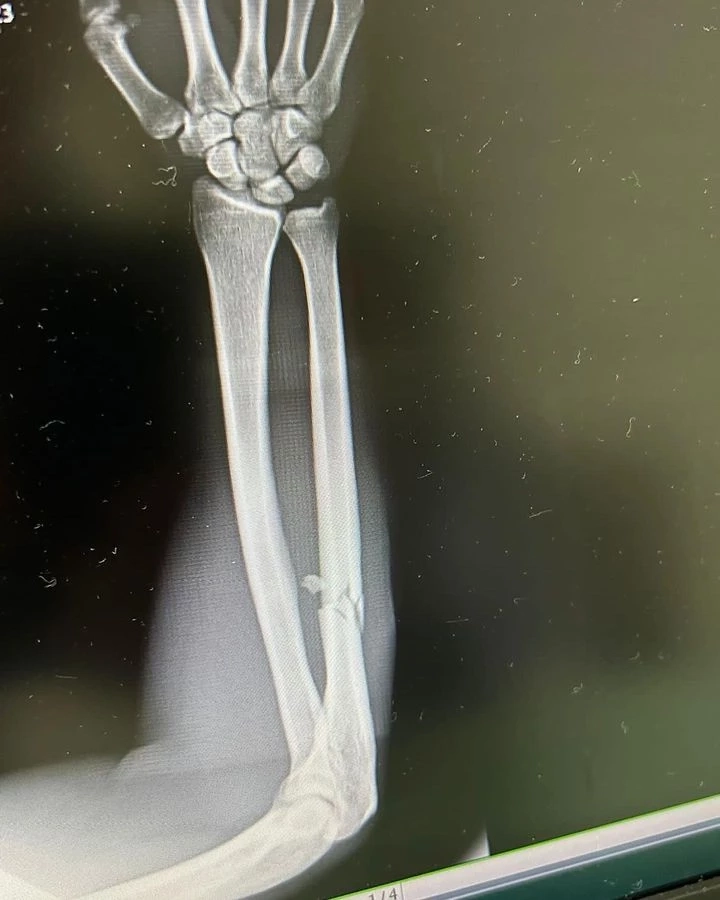 เผยภาพเอ็กซ์เรย์ "ดาวิต คิเรีย" หลังโดนลูกเตะ "ตะวันฉาย" ทำพ่าย TKO