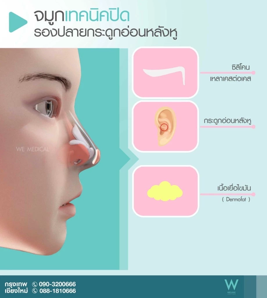 เสริมจมูกแบบปิด