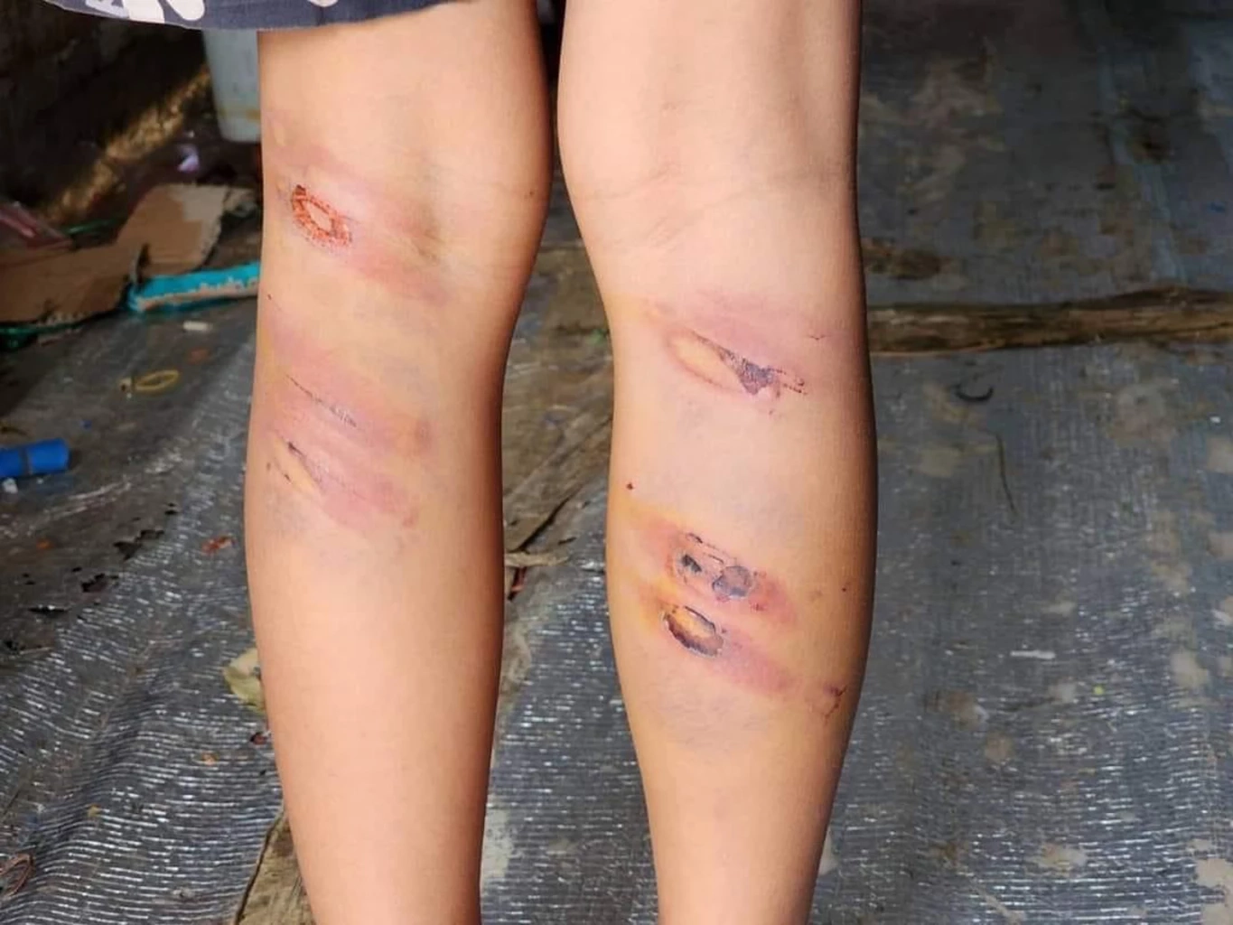 สุดทน พ่อหลอนยา ตีลูกจนเป็นแผลทั่วร่าง