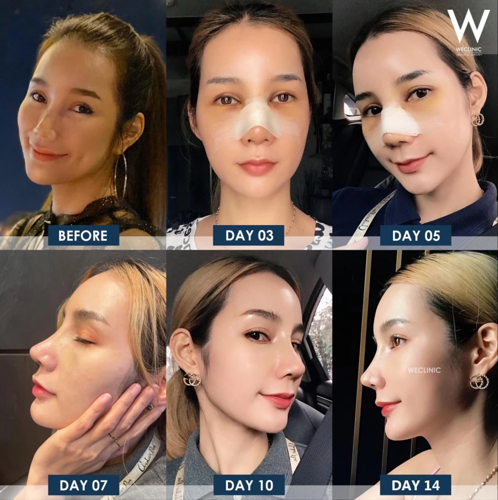 เสริมจมูก คืออะไร? สิ่งที่ควรรู้เกี่ยวกับการศัลยกรรมจมูก