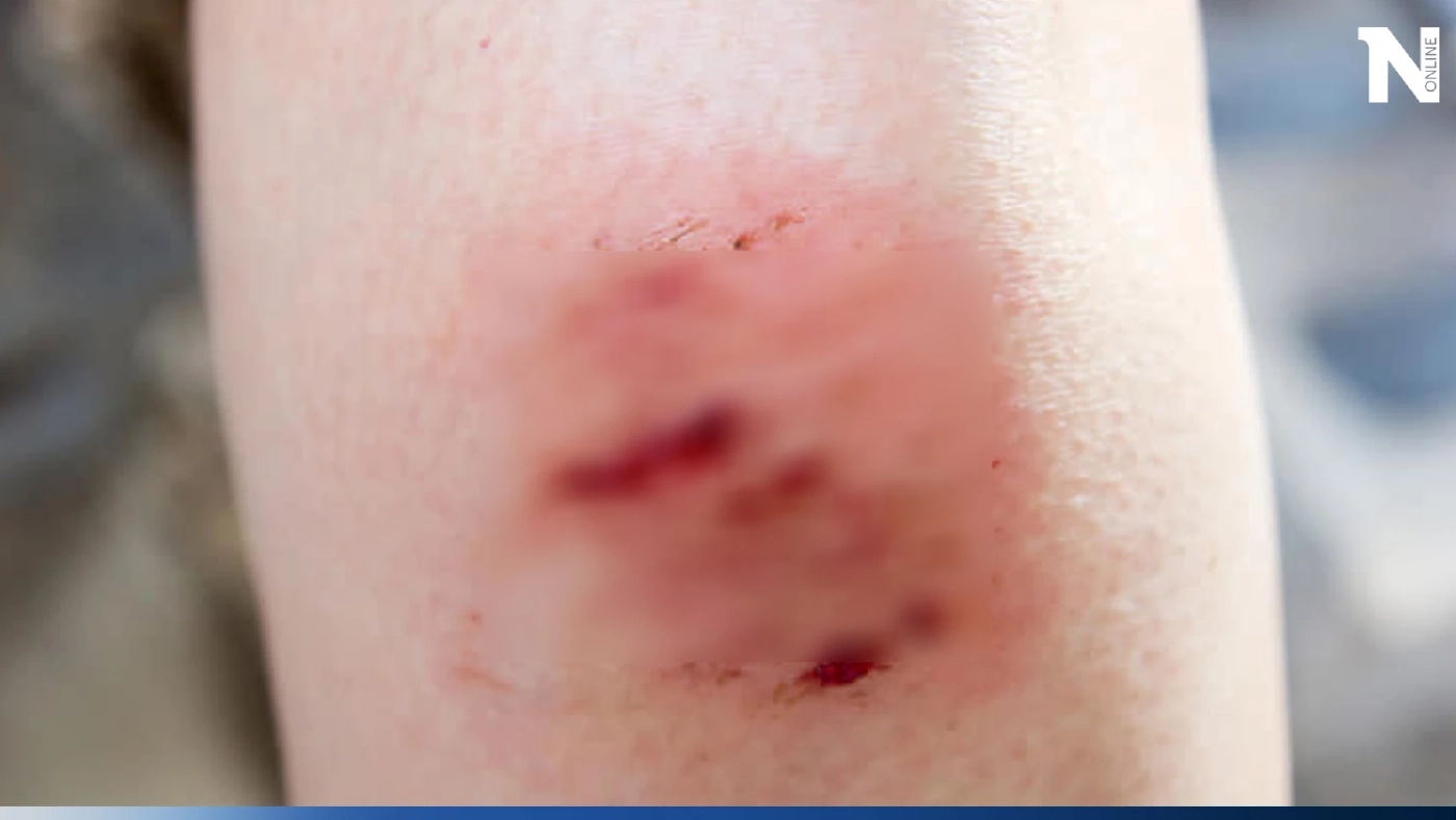 แบคทีเรียกินเนื้อเพิ่มขึ้น เหตุจากโลกร้อน เตือนมีแผลไม่ควรเล่นน้ำทะเล