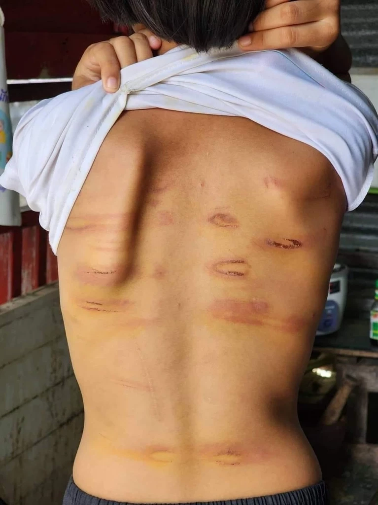 สุดทน พ่อหลอนยา ตีลูกจนเป็นแผลทั่วร่าง