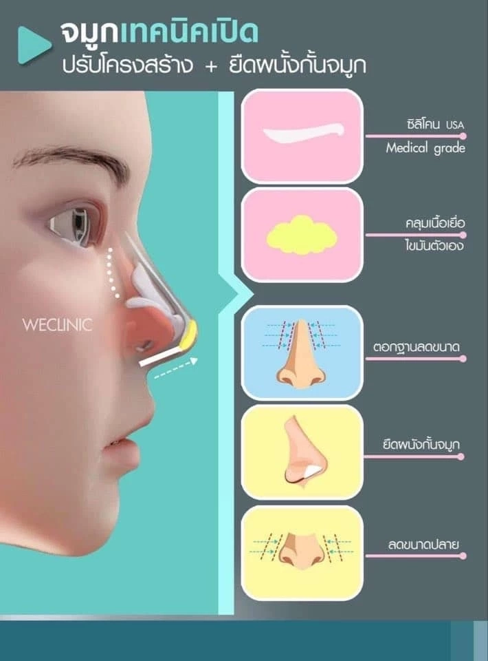 เสริมจมูกแบบโอเพ่น 