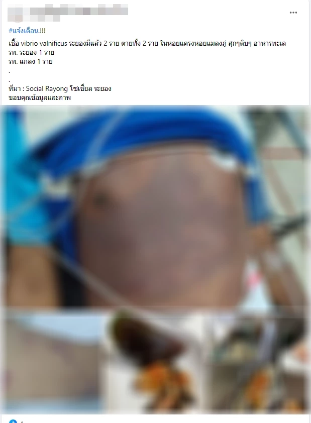 เปิดความจริง"แบคทีเรียกินเนื้อ" ร้ายแค่ไหน คร่าชีวิตแล้ว 2 รายจริงหรือไม่