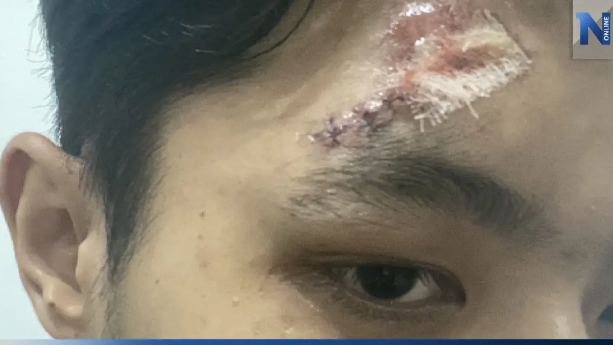 หนุ่มวัย 24 ปี ร้องทนายดังหลังขี่รถสะดุดฝาท่อสูงล้มเย็บศีรษะกว่า 6 เข็ม