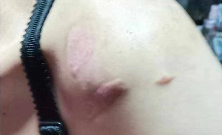 ลูกจ้างร้อง “บิ๊กโจ๊ก” ถูกนายจ้างจุดไฟเผาร่าง จับขังทรมานนานเป็นปี 