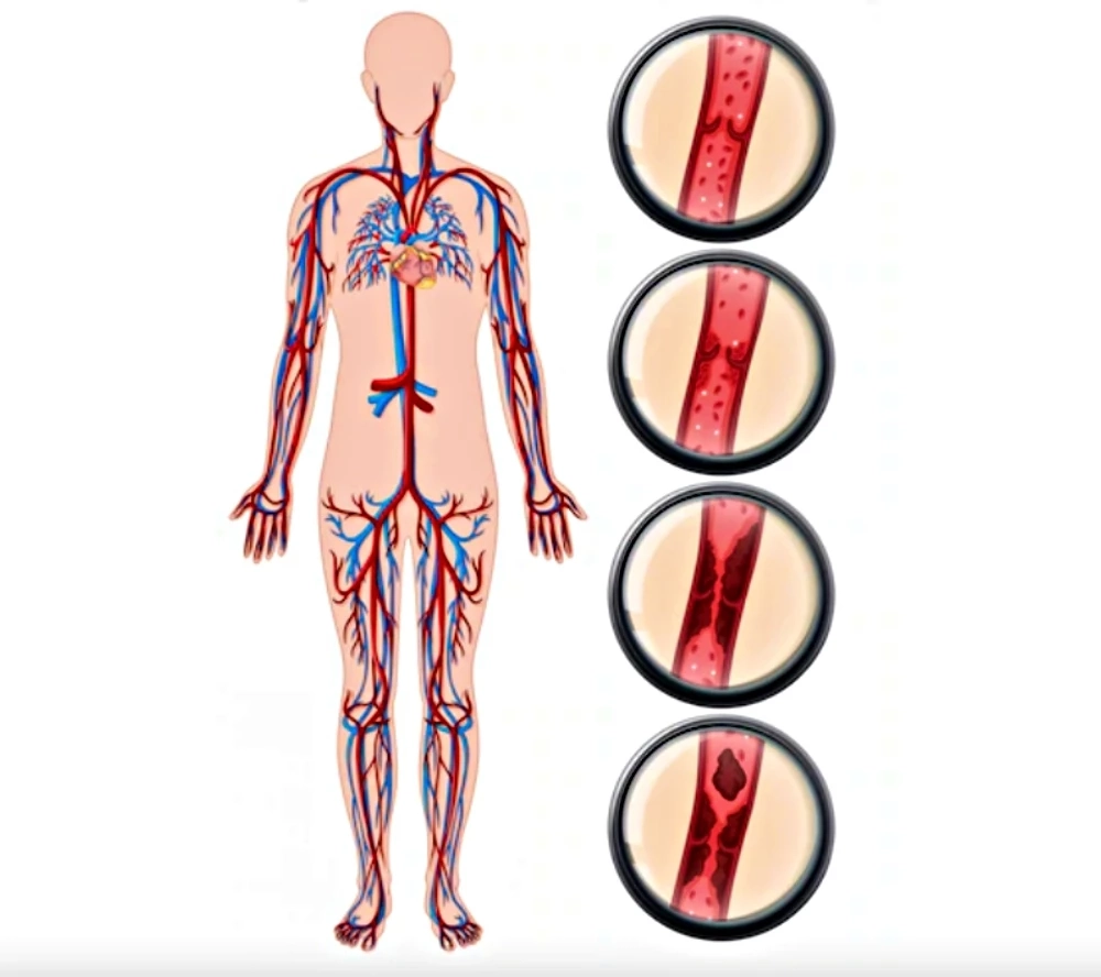 เปิด 5 สัญญาณเสี่ยง 'ภาวะหลอดเลือดอุดตัน' อันตรายที่คร่าชีวิตผู้คนทั่วโลก