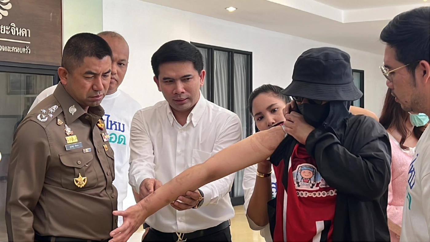 ลูกจ้างร้อง “บิ๊กโจ๊ก” ถูกนายจ้างจุดไฟเผาร่าง จับขังทรมานนานเป็นปี 