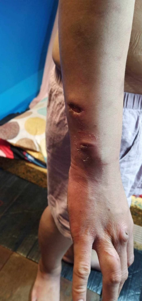 ลูกจ้างร้อง “บิ๊กโจ๊ก” ถูกนายจ้างจุดไฟเผาร่าง จับขังทรมานนานเป็นปี 