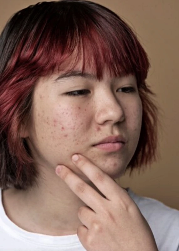 เตือนผู้หญิงน้ำหนักเกิน-รอบเดือนเลื่อน เสี่ยงถุงน้ำรังไข่หลายใบ (PCOS)