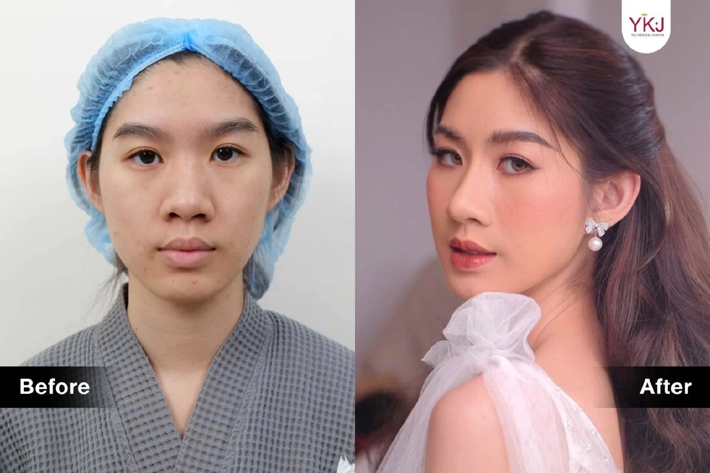 ทำไมต้องแก้จมูก? เรื่องที่ควรรู้ก่อนแก้จมูก