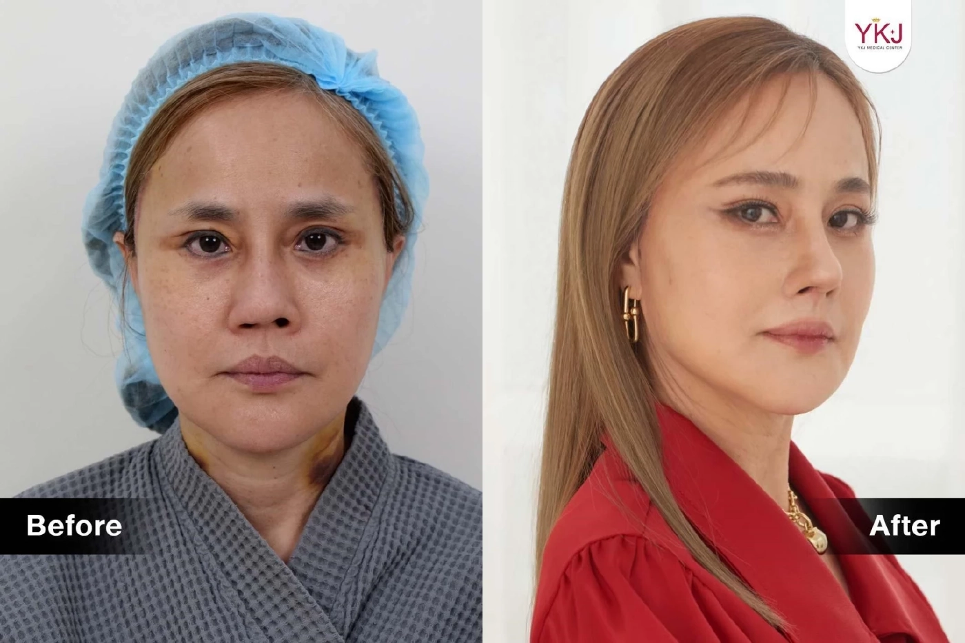 ทำไมต้องแก้จมูก? เรื่องที่ควรรู้ก่อนแก้จมูก