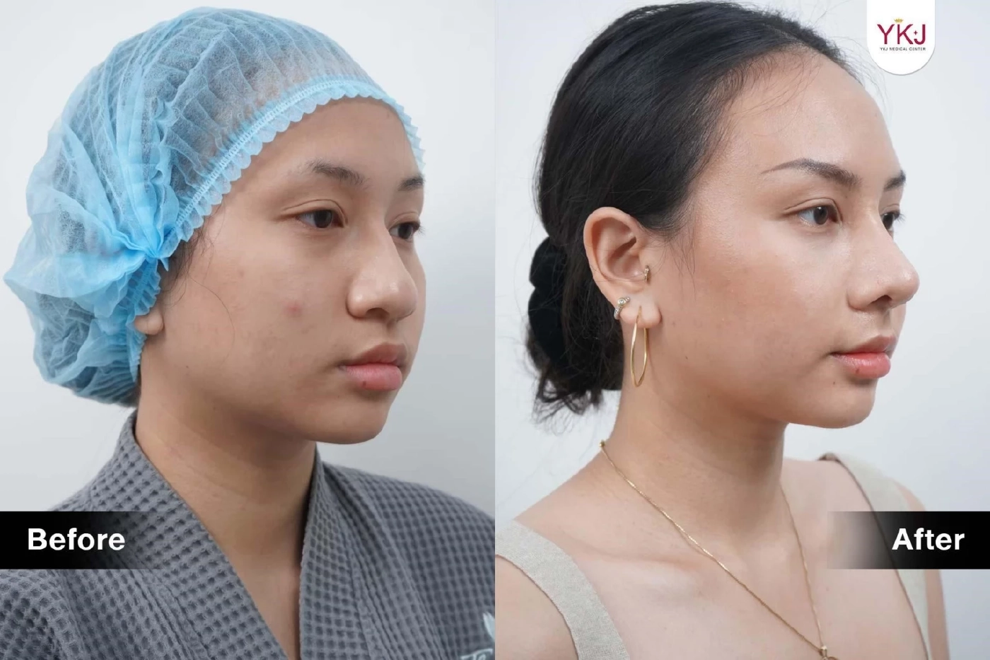 ทำไมต้องแก้จมูก? เรื่องที่ควรรู้ก่อนแก้จมูก