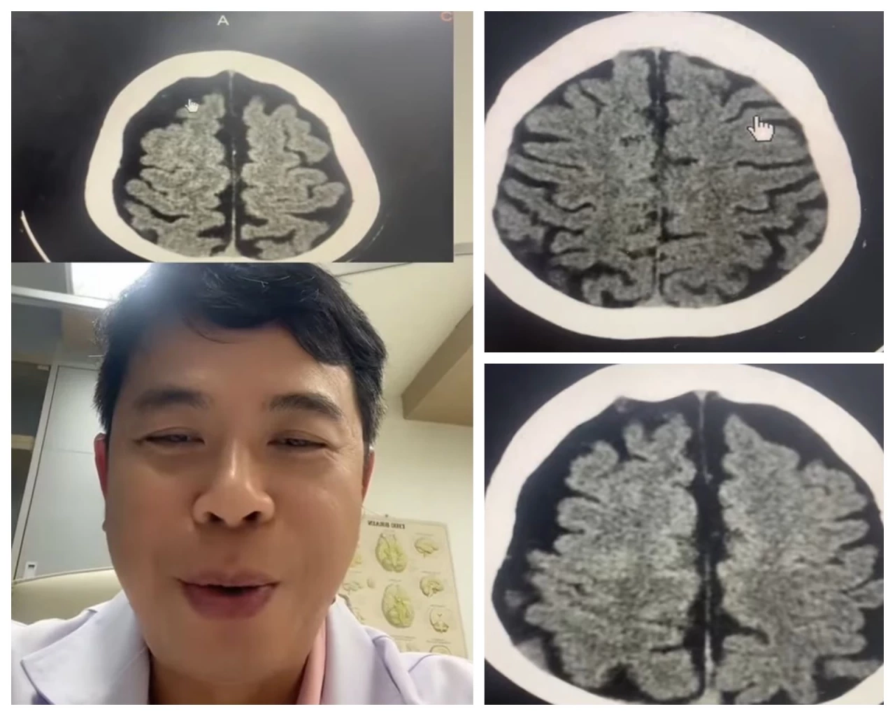 หมอสมองเทียบภาพความต่างของชายสูบบุหรี่วันละซองกับหญิงชราเตือนนักสูบ