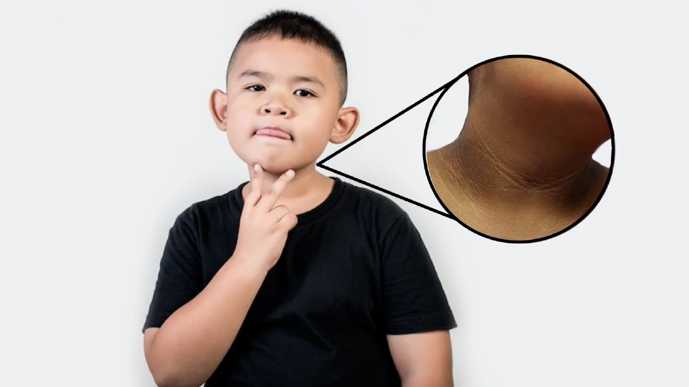 “ปื้นดำที่คอ” อาจไม่ใช่แค่ขี้ไคล แต่เป็นสัญญาณเตือน “โรคเบาหวานในเด็ก”