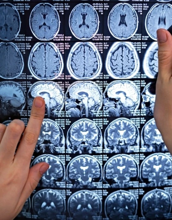 การตรวจวินิจฉัยภาวะเส้นเลือดในสมองโป่งพอง