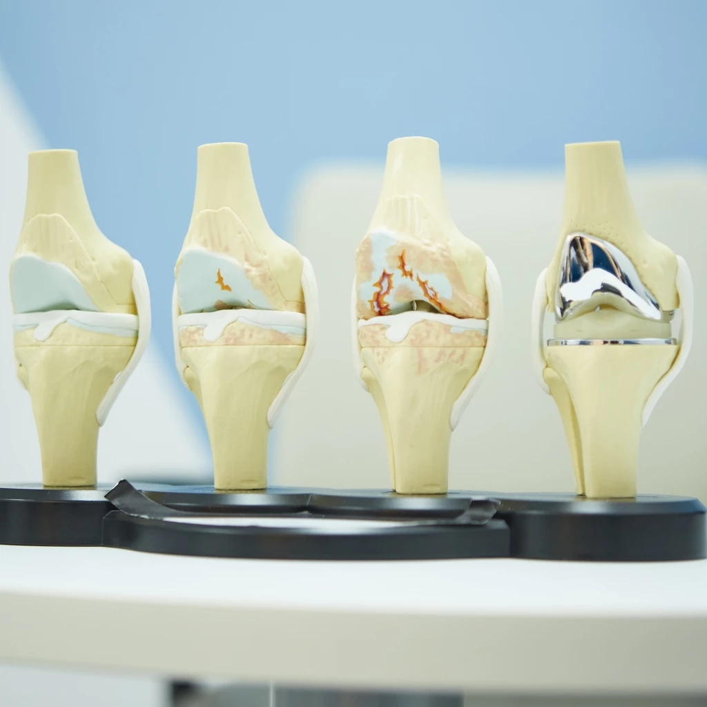 ปวดข้อ บวมแดง อาจเป็น "โรคข้อเข่าเสื่อม" ภาวะเข่าสึกหรอที่เป็นได้ทุกวัย