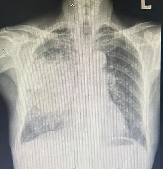งานวิจัยแพทย์ มช. ระบุ "PM2.5" ต้นเหตุ "มะเร็งปอด" เชียงใหม่-ลำปางดับสูงสุด