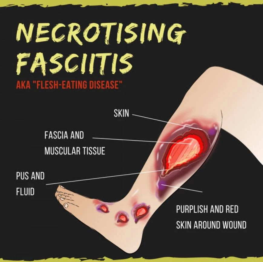 แบคทีเรียกินเนื้อคน ไม่ได้มีชนิดเดียว "หมอยง" ชี้เกิดกับผู้ภูมิคุ้มกันต่ำ