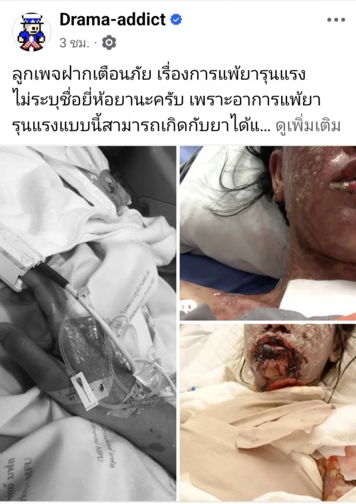 หมอเผยเป็นโรคนี้! เพจดังโพสต์เตือนภัย สาวแพ้ยาขั้นรุนแรง