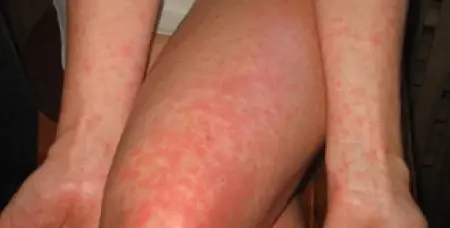 โรคไข้อีดำอีแดงระบาด! ผู้ปกครองอย่าชะล่าใจ หมั่นดูแลบุตรหลานให้ดี