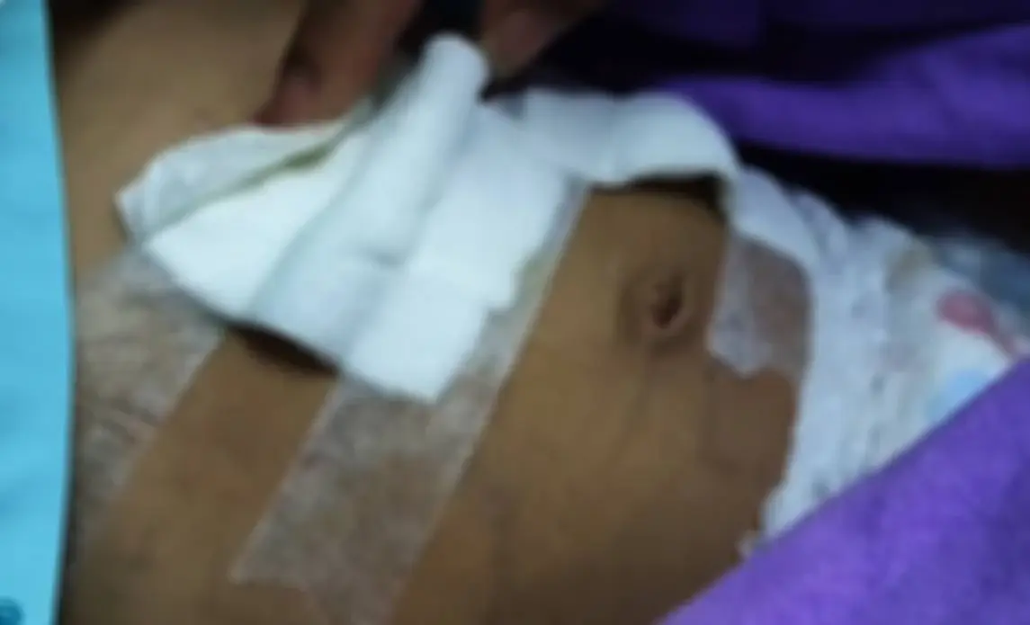 สยอง! ด.ช. 4 ขวบ ถูกตัด "ลำไส้-กระเพาะ" บางส่วนออก หลังดื่มสิ่งนี้