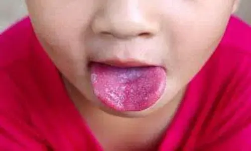 โรคไข้อีดำอีแดงระบาด! ผู้ปกครองอย่าชะล่าใจ หมั่นดูแลบุตรหลานให้ดี