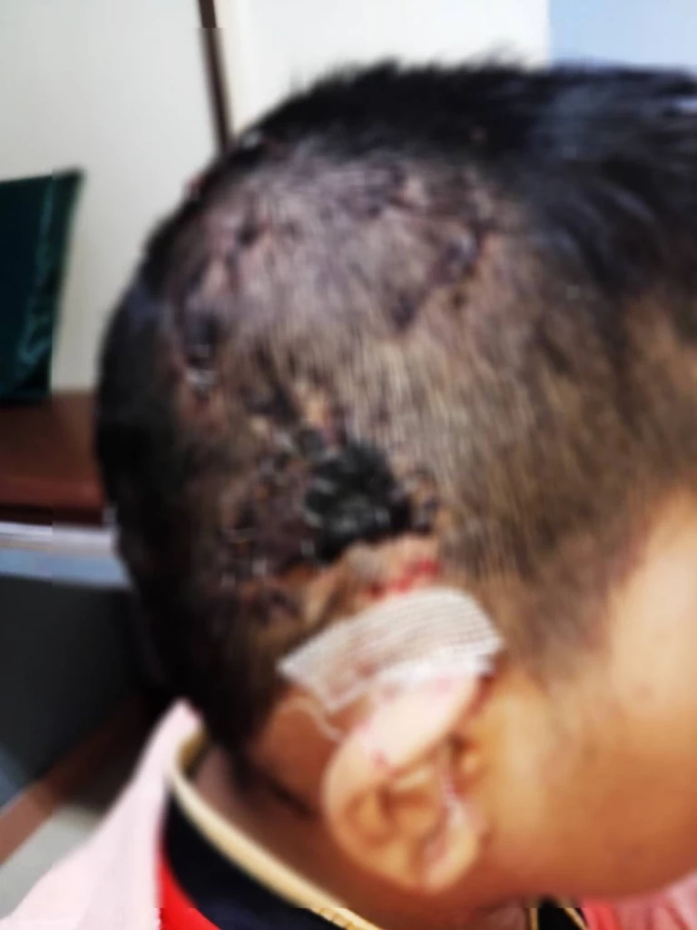 เหยื่อ "พิตบูล" ขย้ำ 10 ขวบ เจ็บสาหัส เตรียมร้อง “ผู้ช่วย รมว.สาธารณสุข”