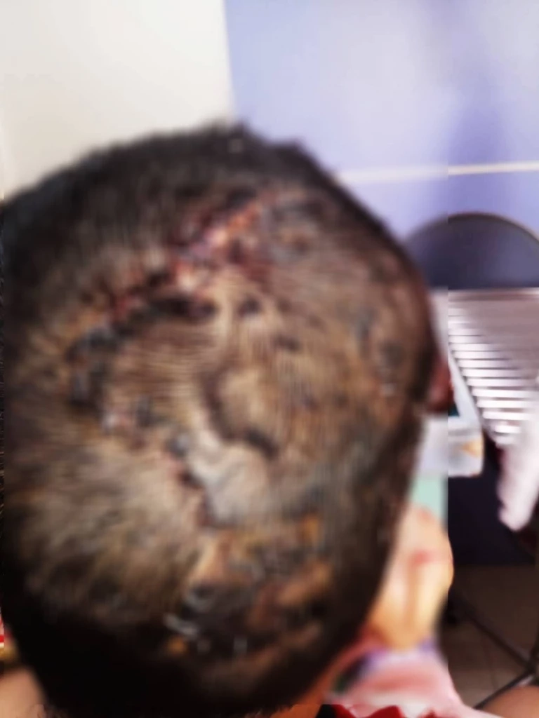 เหยื่อ "พิตบูล" ขย้ำ 10 ขวบ เจ็บสาหัส เตรียมร้อง “ผู้ช่วย รมว.สาธารณสุข”