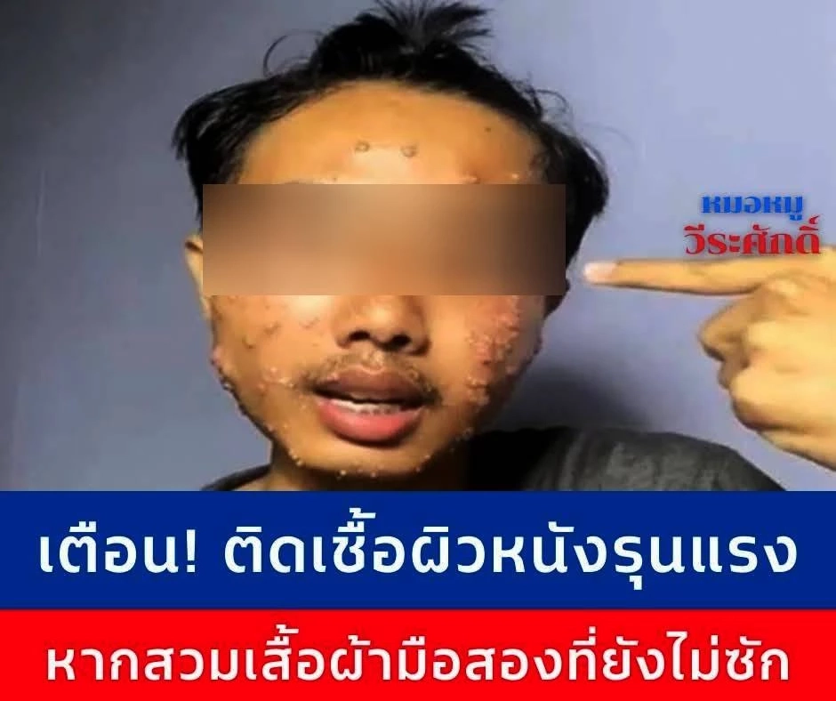 เตือน! "หมอหมู" ระบุุติดเชื้อผิวหนังรุนแรง หากสวมเสื้อผ้ามือสองที่ยังไม่ซัก