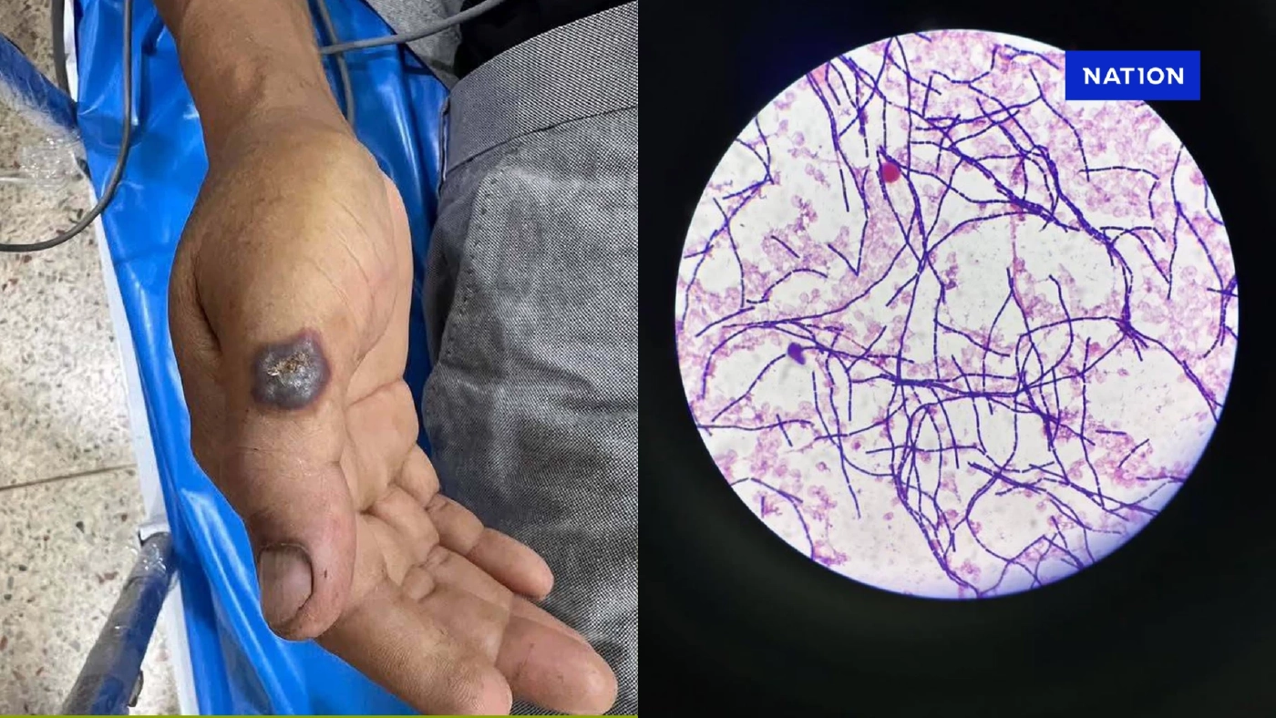 อัปเดตสถานการณ์ "โรคแอนแทรกซ์" มุกดาหาร พบกลุ่มเสี่ยง 638 ราย