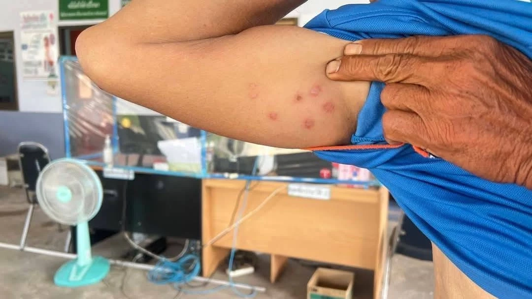 หนองบัวลำภู พบผู้ต้องสงสัยติดเชื้อ "แอนแทร็กซ์" รอผลแลปยืนยัน