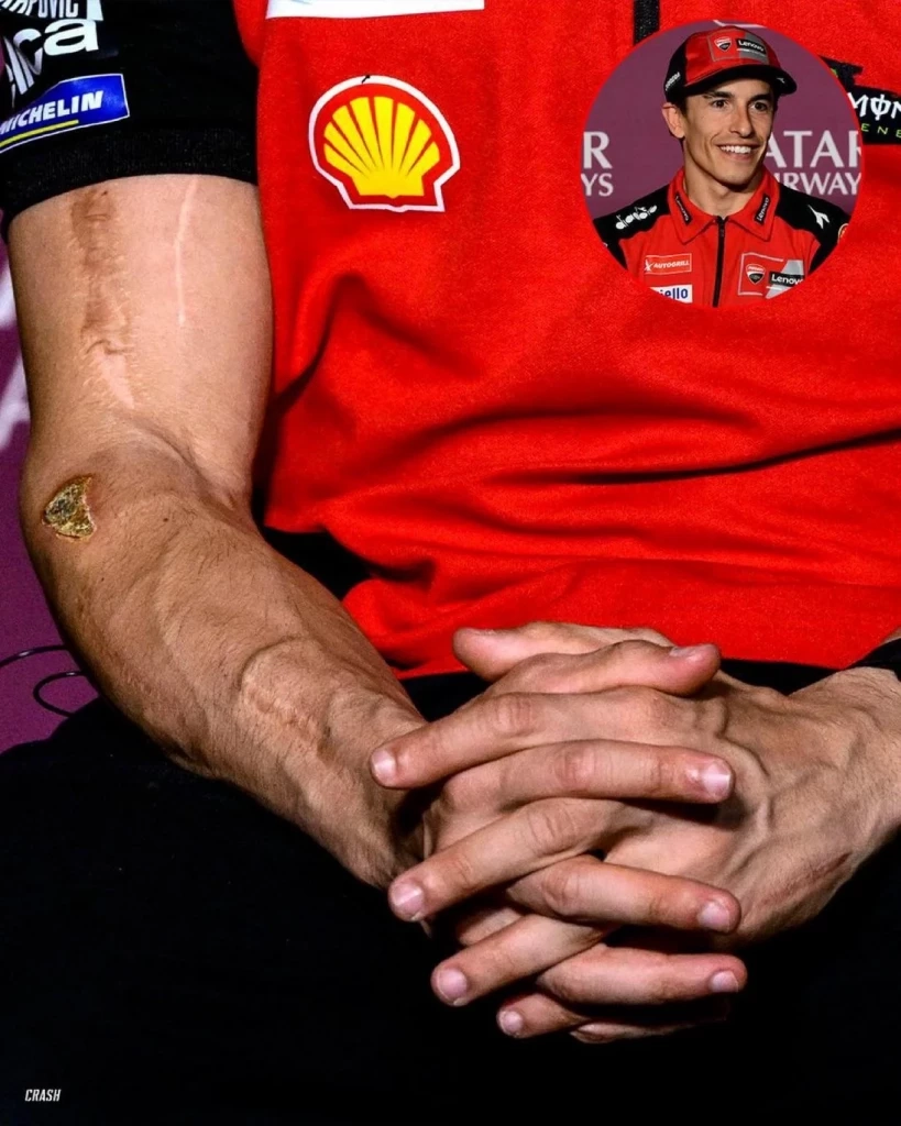 แผลเป็นของ มาร์ค มาร์เกซ จากการผ่าตัดครั้งแล้วครั้งเล่า (ภาพ: Reddit via Crash.net)