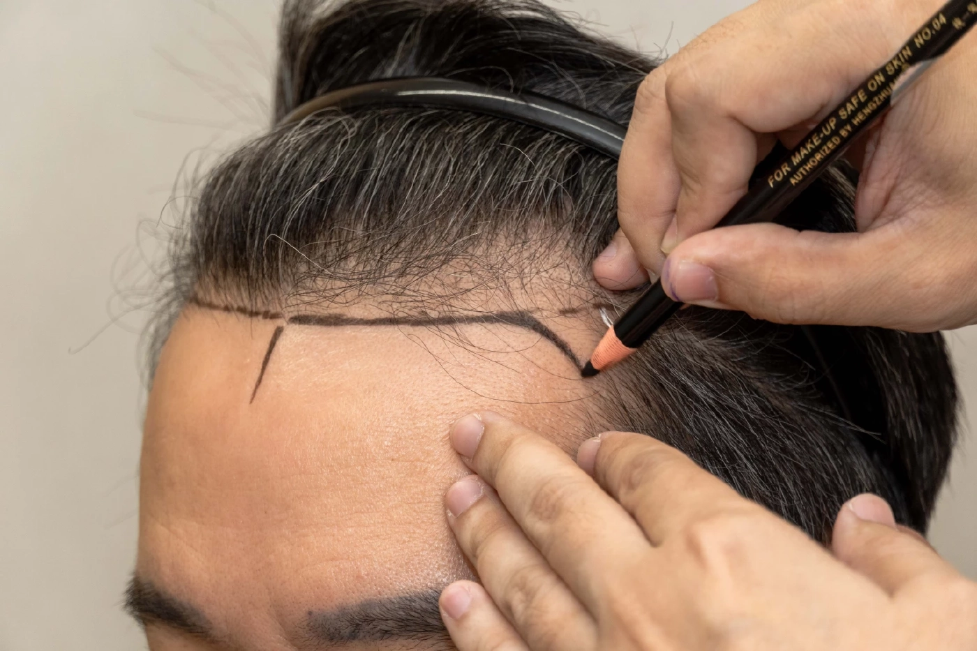 เมดพาร์คเปิดตัว “ศูนย์ปลูกถ่ายเส้นผม” ชูมาตรฐานโรงพยาบาล-ทีมแพทย์ระดับโลก