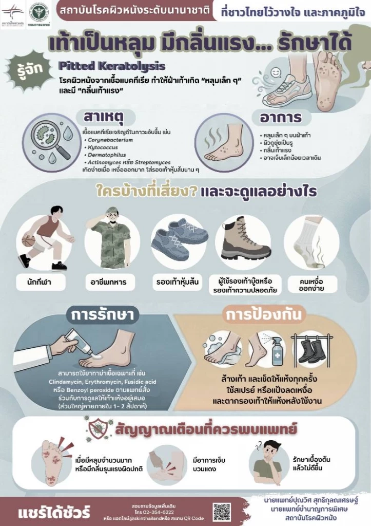 รู้จัก Pitted Keratolysis โรค “กลิ่นเท้าแรง ผิวเท้าเป็นรู” รักษาให้หายขาดได้