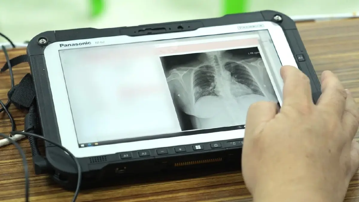 อบจ.เพชรบูรณ์ เดินหน้า“Health Connect” ส่งนวัตกรรมรถเอกซเรย์เคลื่อนที่ฯ คัดกรองวัณโรค-ปอด เชิงรุก ด้วยเทคโนโลยีปัญญาประดิษฐ์ (AI)  สู่ชุมชน