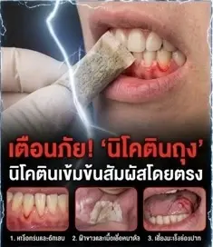 หมอฟันไทย-สสส. จี้แบน "นิโคตินถุง" หลังพบเคสใช้ 5 เดือนเนื้อเยื่อช่องปากพังเสี่ยงมะเร็ง