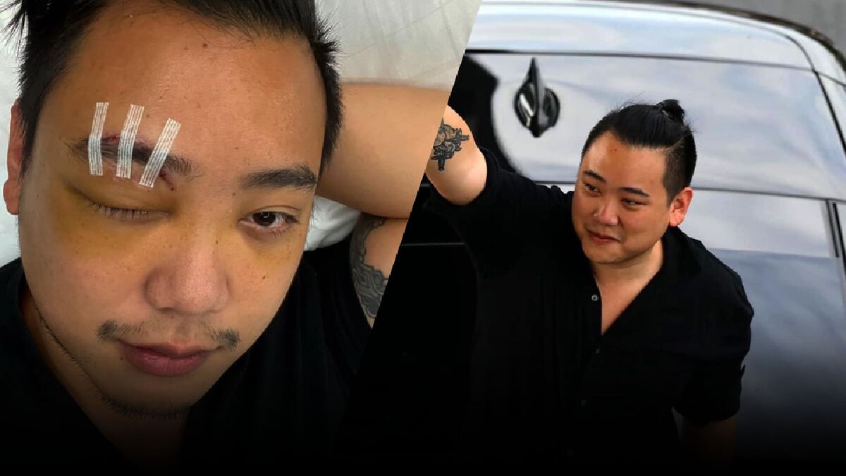 "ไฮโซลูกนัท" โพสต์โชว์บาดแผลรักษาดวงตาขวา พร้อมลั่นผมกลับมาแล้ว "ไฮโซลูกนัท" โพสต์โชว์บาดแผลรักษาดวงตาขวา พร้อมลั่นผมกลับมาแล้ว
