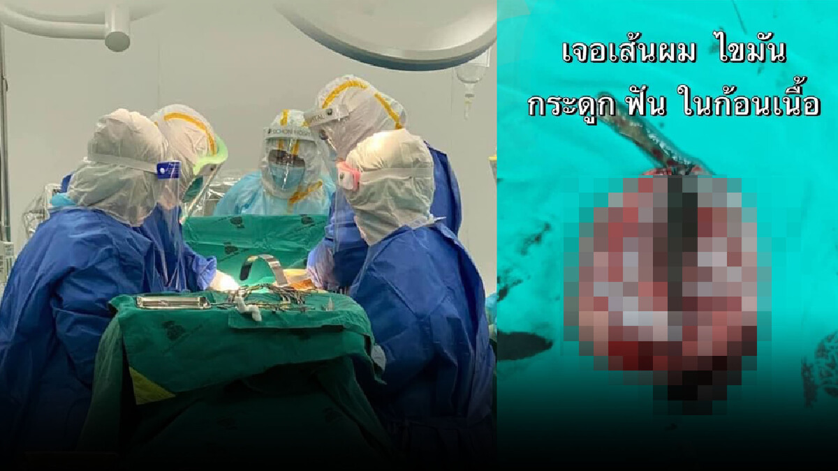 หมอแจงไม่ใช่คุณไสย! หลังผ่าเนื้องอกในท้อง เจอเส้นผม กระดูก เล็บ ฟัน