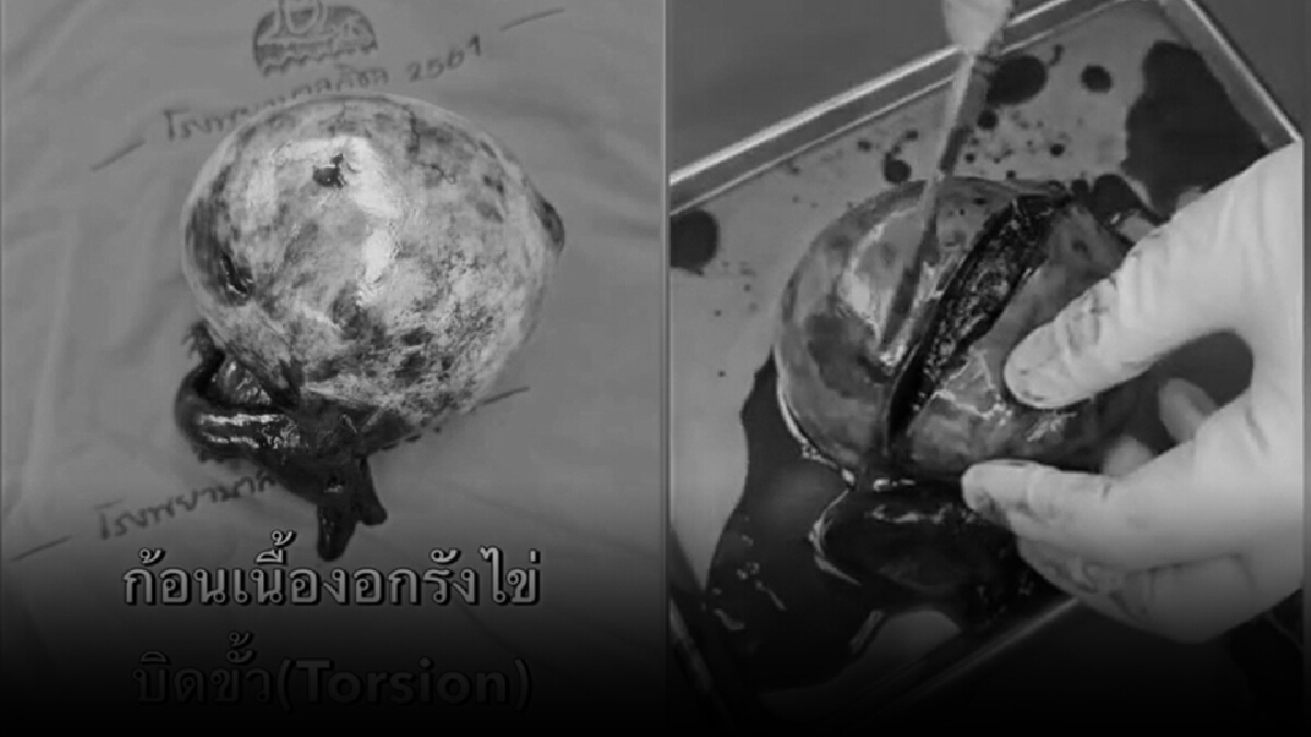 ผงะ!! หมอเมืองคอนแจงเจอเส้นผมในเนื้องอกช่องท้องไม่ใช่ไสยศาสตร์
