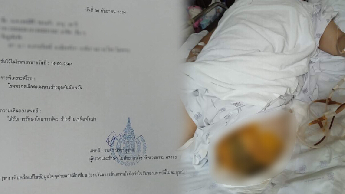 ญาติเชื่อ นศ.ถูกตัดขาเพราะวัคซีนแอสตร้าเข็ม 2 แบบไขว้ ญาติเชื่อ นศ.ถูกตัดขาเพราะวัคซีนแอสตร้าเข็ม 2 แบบไขว้