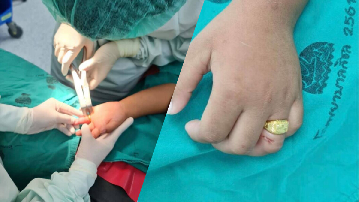 อุทาหรณ์! ยายรับขวัญหลาน 3 ขวบ ใส่แหวนทองให้สุดท้ายถอดไม่ออกต้องผ่าตัด อุทาหรณ์! ยายรับขวัญหลาน 3 ขวบ ใส่แหวนทองให้สุดท้ายถอดไม่ออกต้องผ่าตัด