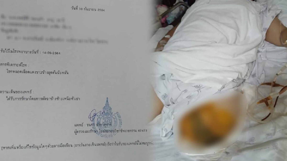 สปสช.จ่าย 4 แสน นศ.พังงา ถูกตัดขาหลังฉีดวัคซีนไขว้เข็ม 2
