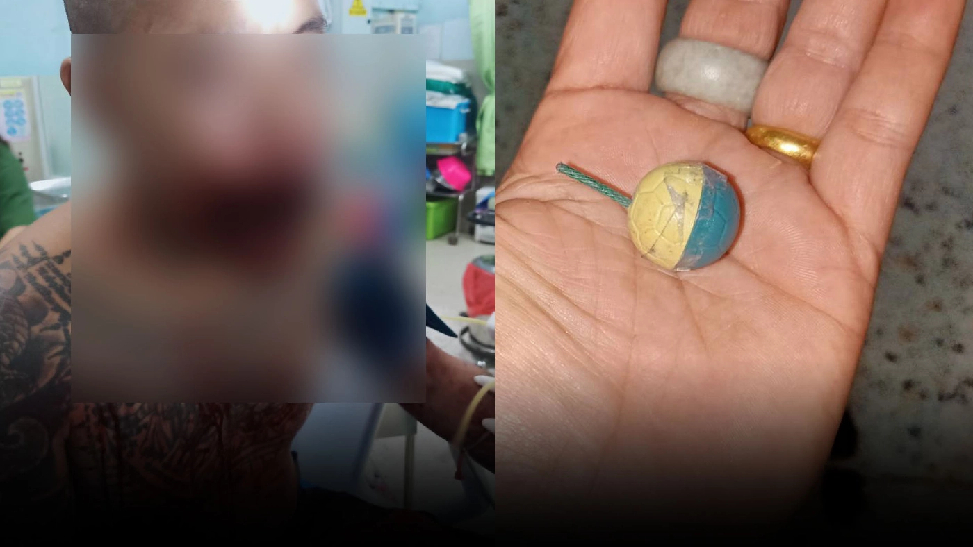 อดีตทหารพราน ลองของอมประทัดลูกบอลโชว์ ระเบิดใส่ปากเละ