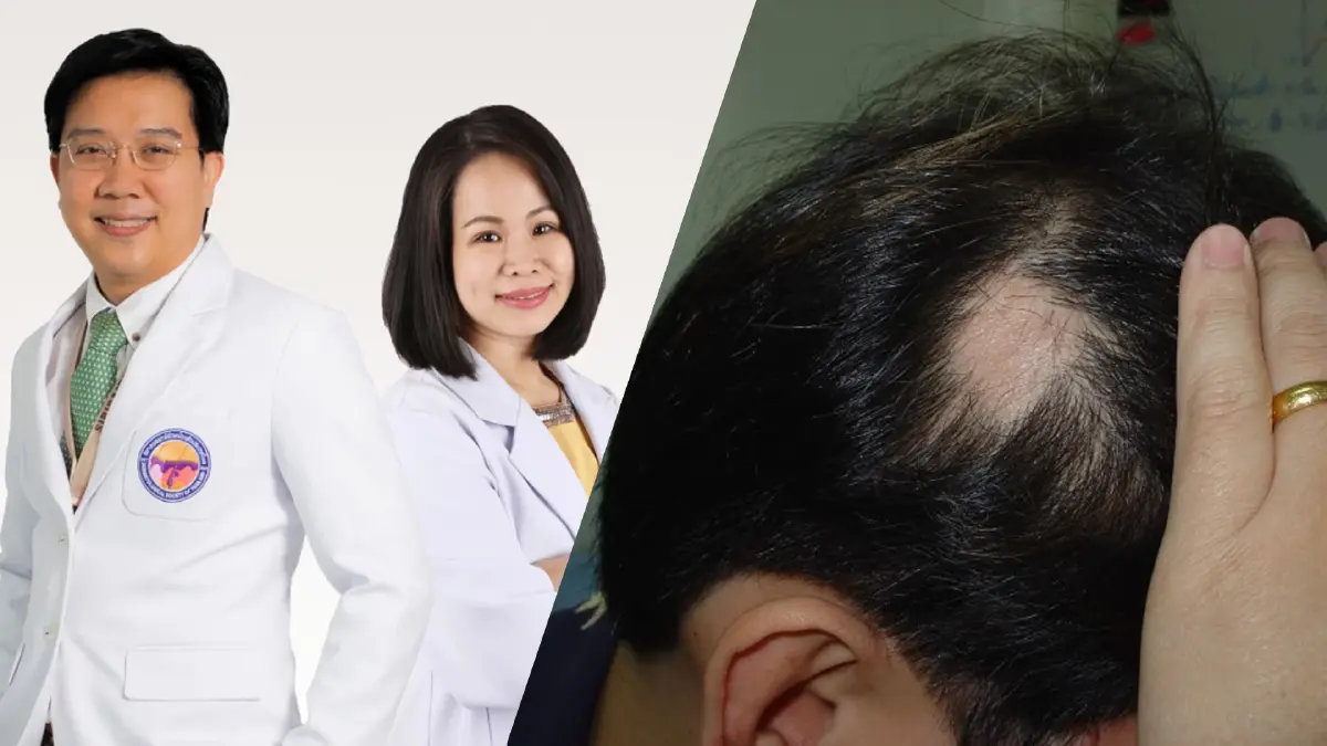 แพทย์ผิวหนัง ไขข้อข้องใจ  “ฉีดวัคซีนโควิด-19 ผมร่วง” จริงหรือ?