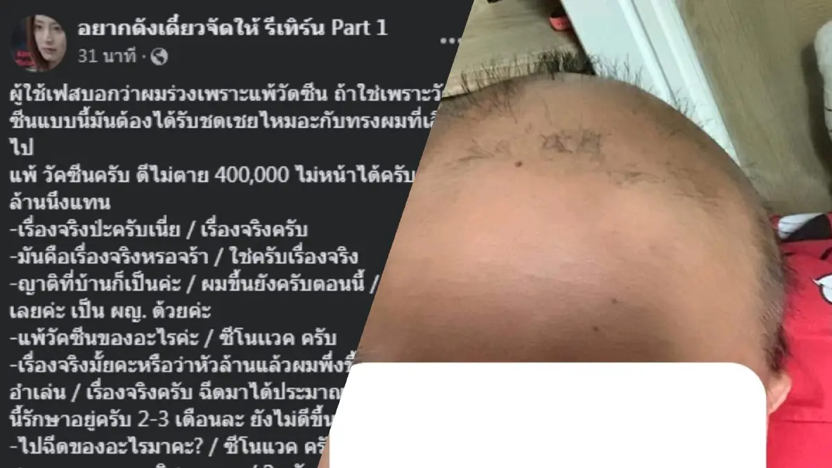 แชร์สนั่น! หนุ่มนักกีฬาฉีดวัคซีน "ซิโนแวค" แพ้ผมร่วงเกือบหมดศีรษะ แชร์สนั่น! หนุ่มนักกีฬาฉีดวัคซีน "ซิโนแวค" แพ้ผมร่วงเกือบหมดศีรษะ